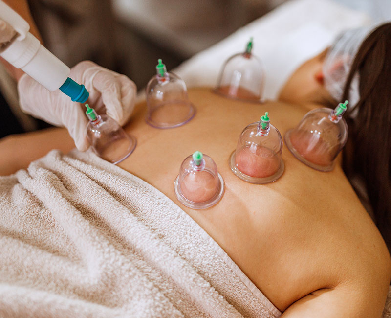 Cupping therapy